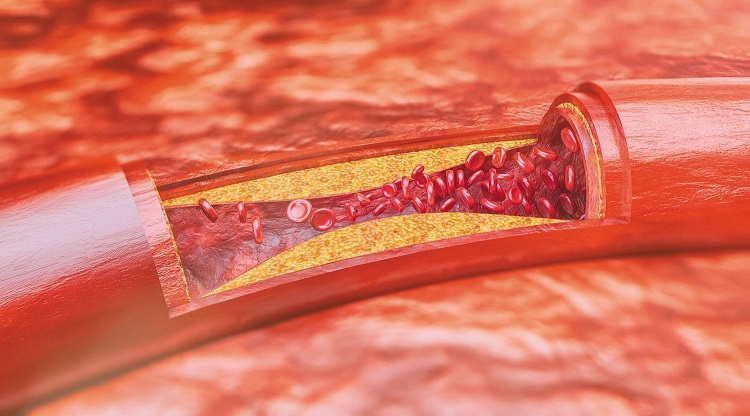 Xơ vữa động mạch là hiện tượng dày và cứng lên của thành các động mạch