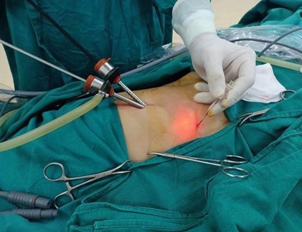 Phương pháp tán sỏi ống mật chủ qua da được thực hiện qua một vết mổ rất nhỏ