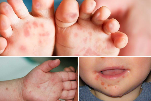 Ở giai đoạn toàn phát, trẻ thường xuất hiện nốt phát ban ở lòng bàn tay, bàn chân, quanh miệng