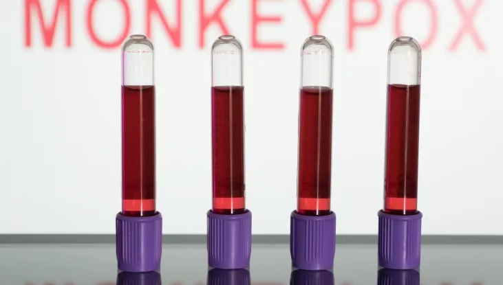 Xét nghiệm máu là một trong những phương pháp giúp phát hiện virus bệnh đậu mùa khỉ - Ảnh: Getty Images