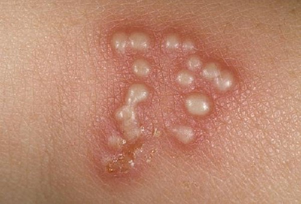 Herpes gây ra các vết loét quanh niêm mạc miệng, môi hoặc bộ phận sinh dục