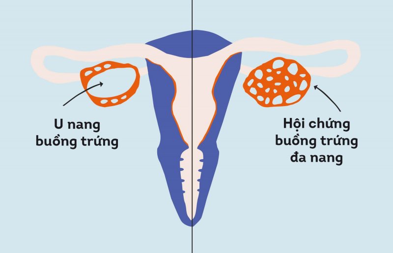Ảnh hưởng của u nang buồng trứng tới khả năng sinh sản nhẹ hơn so với buồng trứng đa nang