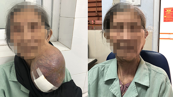 Hình ảnh trước và sau khi được bóc tách khối u cho cụ bà 85 tuổi - Ảnh: BVCC