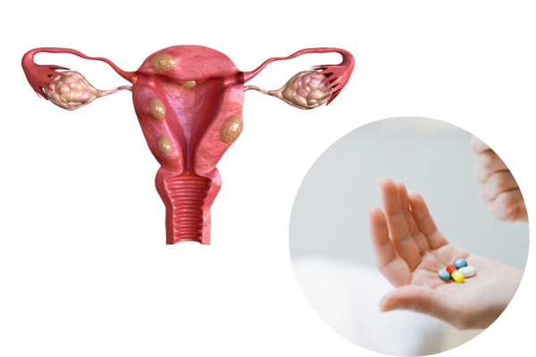 Sử dụng nội khoa chữa u xơ tử cung là giải pháp trị bệnh tạm thời