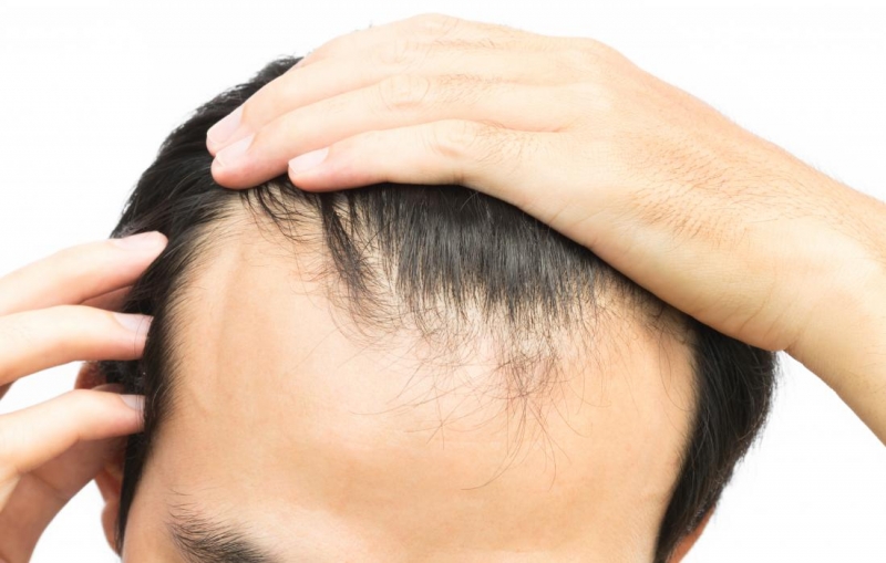 Đường chân tóc lùi cao cũng cảnh báo bạn có thể gặp phải tình trạng hói đầu