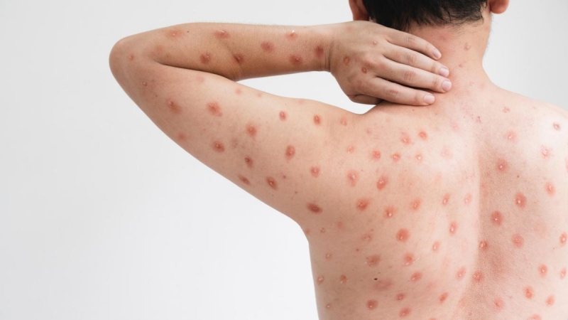 Những nốt phan ban đỏ đặc trưng trên da của người bệnh mắc cúm cà chua - Ảnh: Getty Images