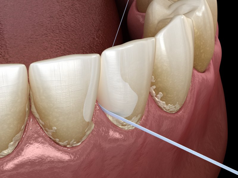 Chỉ nha khoa giúp loại bỏ các mảng bám cứng đầu quanh kẽ răng