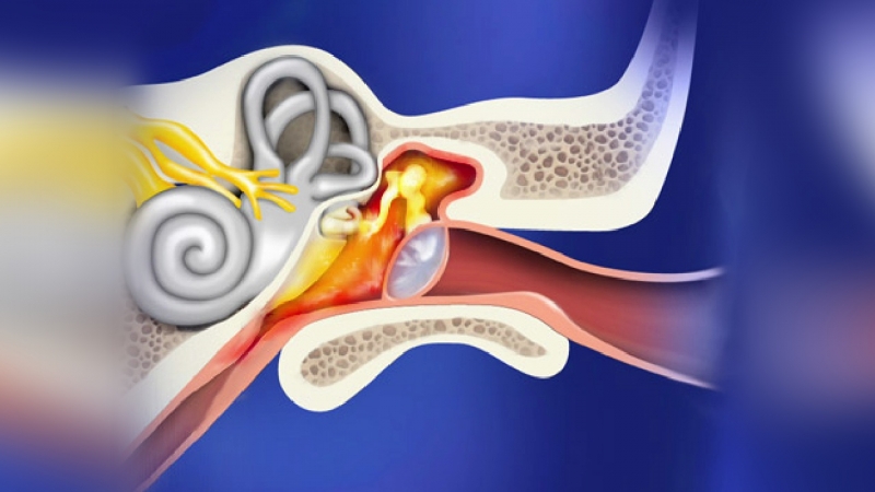 Viêm tai giữa khiến tai chảy nước và giảm sức nghe