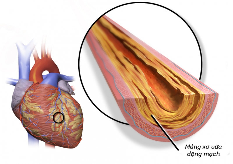 Sự hình thành của các mảng xơ vữa bám trong động mạch tăng nguy cơ mắc bệnh mạch vành
