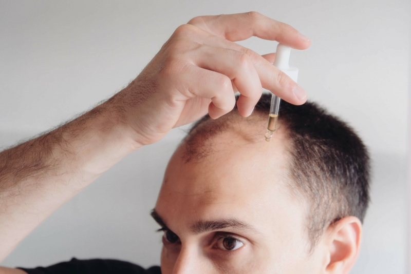 Nhỏ liều lượng Minoxidil vừa đủ (1ml hoặc theo hướng dẫn) lên da đầu