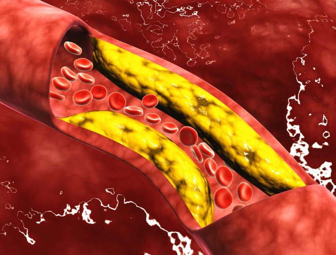 Cholesterol cao là nguyên nhân làm hạn chế máu lưu thông