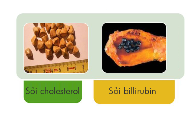 Sỏi mật bilirubin thường có màu sẫm hơn so với sỏi mật cholesterol