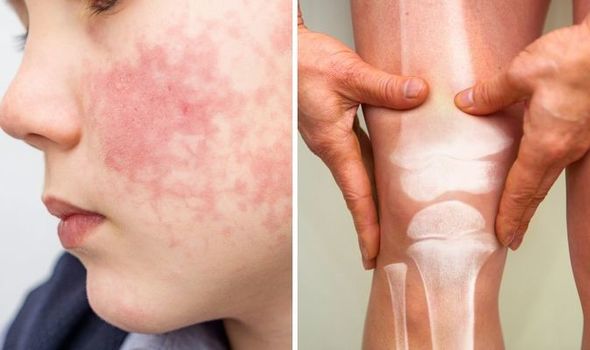 Lupus ban đỏ không chỉ ảnh hưởng tới làn da mà còn gây nhiều biến chứng nguy hiểm