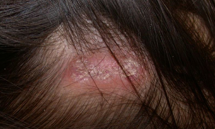 Rụng tóc do lupus ban đỏ dạng đĩa