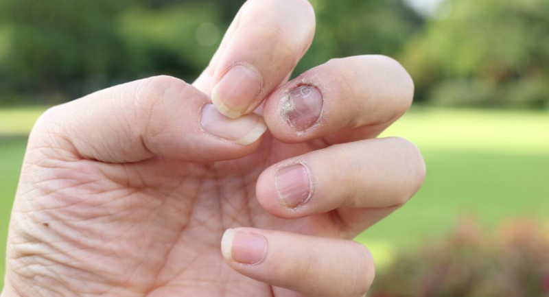 Rối loạn miễn dịch được xem là nguyên nhân chính dẫn đến vảy nến móng tay