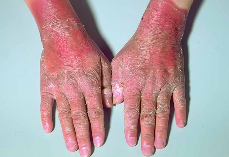 Người mắc pellagra có những tổn thương ngoài da khi tiếp xúc với ánh sáng - Ảnh: Bệnh viện Y Dược TP.HCM