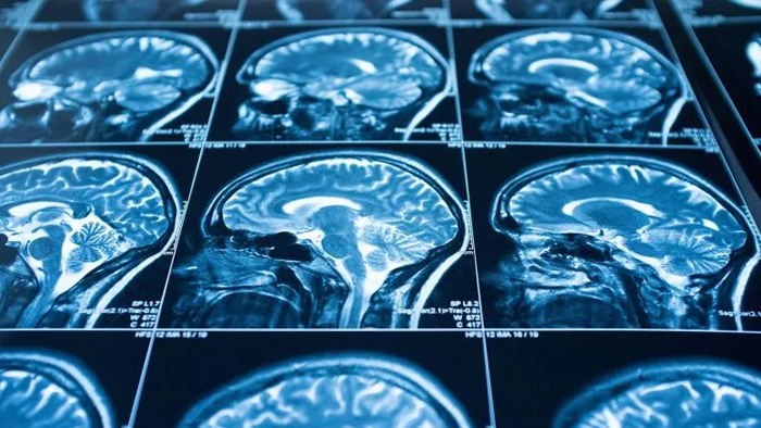 Các tổn thương não có thể cảnh báo nguy cơ sa sút trí tuệ trong tương lai