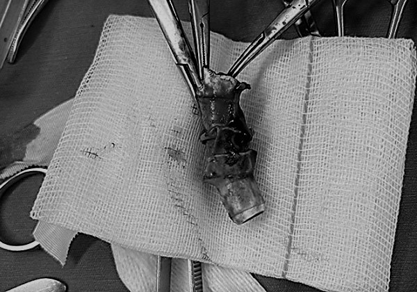 Hình ảnh canuyn gãy được gắp qua can thiệp ống cứng - Ảnh: Bệnh viện Bạch Mai.