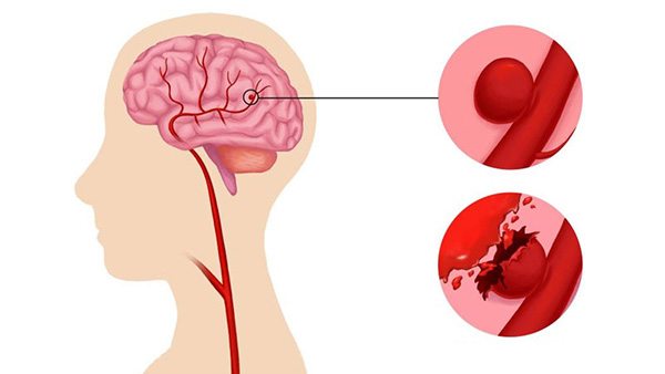 Hiện tượng vỡ mạch máu não có thể để lại nhiều di chứng xấu 