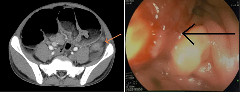 Hình ảnh chụp cắt lớp vi tính ổ bụng của bệnh nhân (bên trái) và hình ảnh nội soi đại tràng của bệnh nhân - Ảnh: BVCC