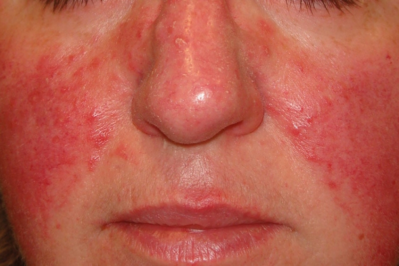 Chứng đỏ mặt gây ra những ban đỏ dai dẳng thường xuyên vùng má, mũi