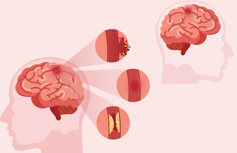 2 thể tai biến mạch máu não chính là xuất huyết não và nhồi máu não (do cục máu đông và mảng xơ vữa) 