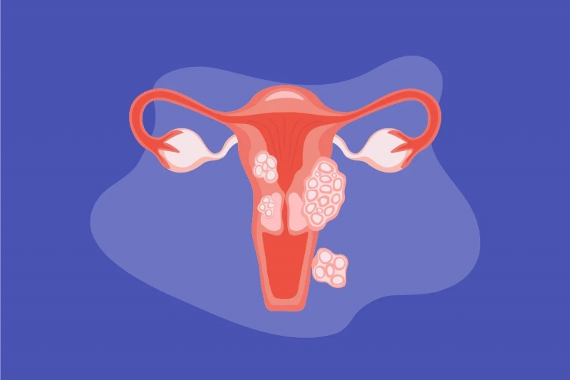 U xơ tử cung liên quan mật thiết đến estrogen và tuổi tác của người phụ nữ