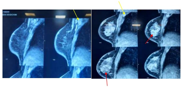 Hình ảnh cộng hưởng từ vú: Tổn thương u vú đa ổ (mũi tên màu đỏ). Hạch nách phải (mũi tên màu vàng) - Ảnh: BVCC