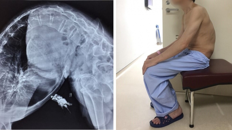 Một ca vẹo cột sống nghiêm trọng đã ngồi thẳng lưng được sau phẫu thuật tại Bệnh Viện TWQĐ 108 - Ảnh: Báo sức khỏe & Đời sống