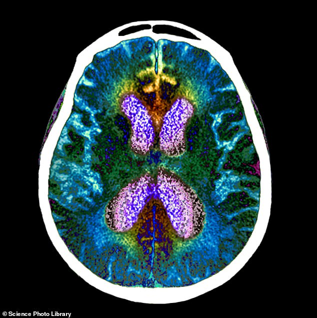 Hình ảnh quét não của người mắc bệnh Alzheimer - Ảnh: Science Photo Library