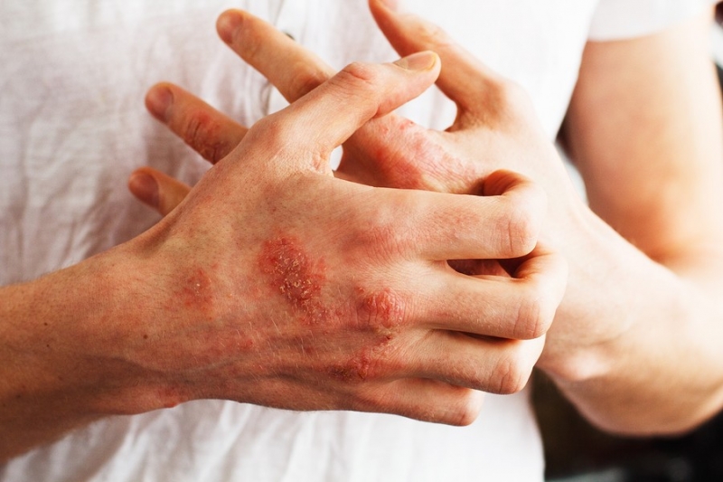 Bệnh chàm eczema gây hiện tượng ngứa ngáy, sưng tấy, mẩn đỏ da