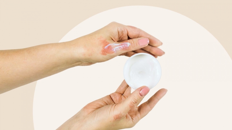 Sử dụng kem dưỡng ẩm làm dịu tình trạng viêm ngứa do eczema và duy trì độ ẩm cho da 