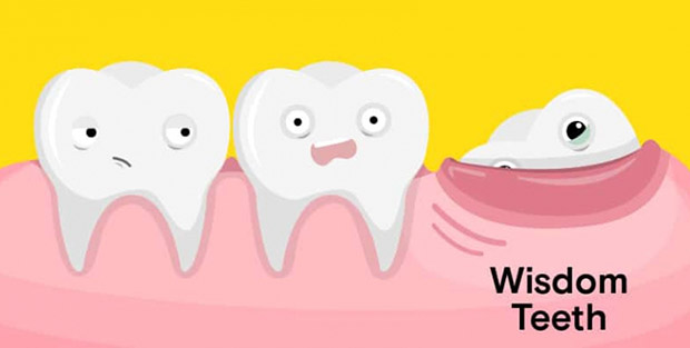 Khi phát hiện thấy đốm trắng trên nưới cuối miệng, đây có thể là dấu hiệu cảnh báo bạn sắp mọc răng khôn 