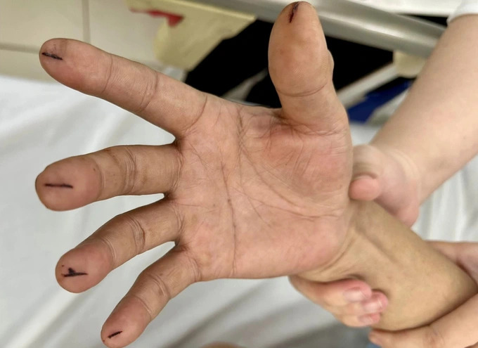 Gia đình bệnh nhân đã cấp cứu theo hướng dẫn trên mạng bằng cách rạch sâu đầu ngón tay - Ảnh: Báo Dân Trí