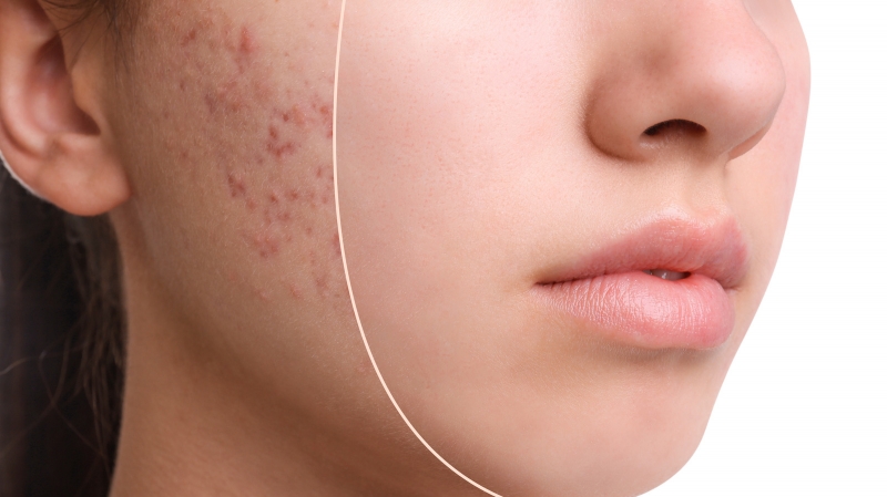 Làm da bị mụn nhạy cảm và dễ bị sẹo, nên cần được bảo vệ bằng kem chống nắng