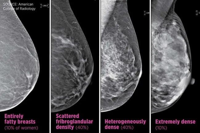 Mật độ của vú trên kết quả chụp X-quang tuyến vú được phân thành 4 mức độ và được ký hiệu bằng các chữ cái A, B, C, D (từ trái qua phải)