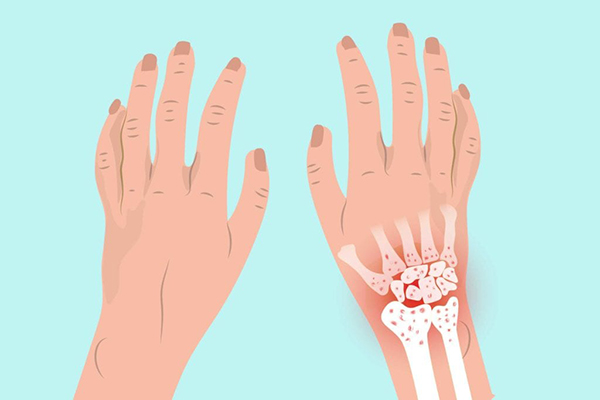Viêm khớp cổ tay xảy ra khi bề mặt sụn ở giữa khớp cổ tay bị mòn dần theo thời gian hoặc do tổn thương