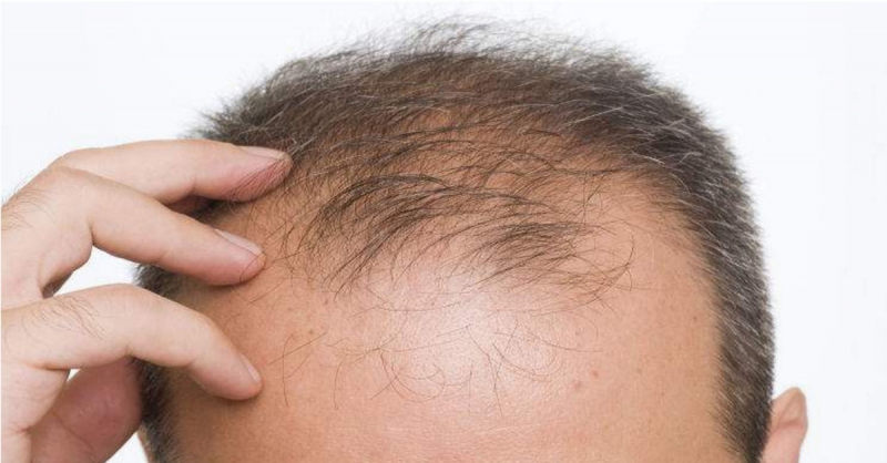 Một số nguyên nhân khác gây rụng tóc: sử dụng thuốc lá điện tử, mất cân bằng hormone...