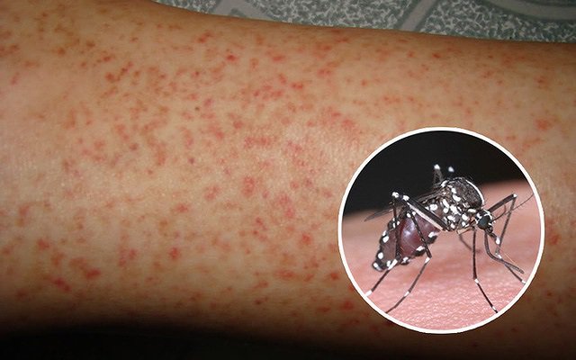 Muỗi Aedes aegypti sẽ truyền virus sốt xuất huyết cho người khỏe mạnh thông qua các vết đốt