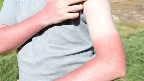 Nếu bị cháy nắng ở cấp độ nặng, da sẽ phát ban đỏ, kèm theo hiện tượng nóng rát khó chịu.