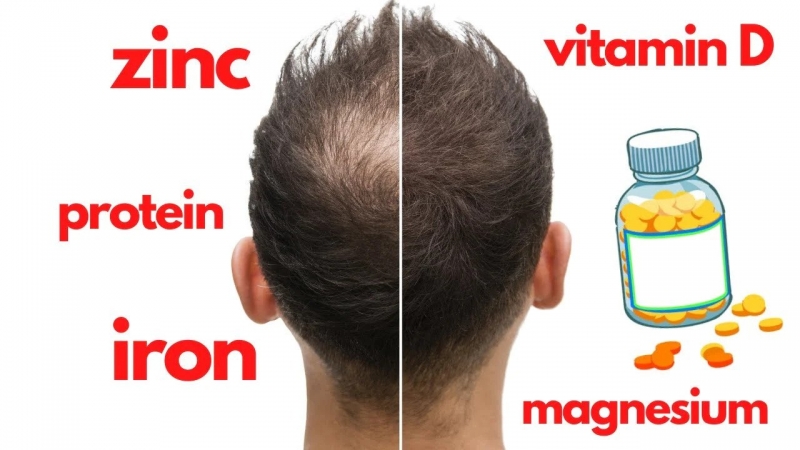 Thiếu kẽm (zinc), sắt (iron) hay vitamin D cũng có thể dẫn đến rụng tóc