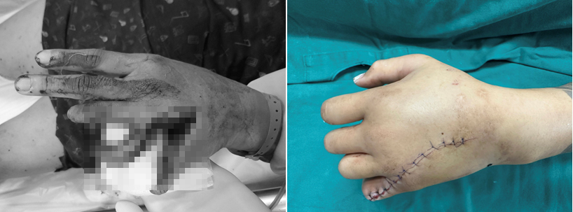 Bàn tay của bệnh nhi trước và sau khi phẫu thuật, hiện đang hồi phục tốt - Ảnh: BVCC