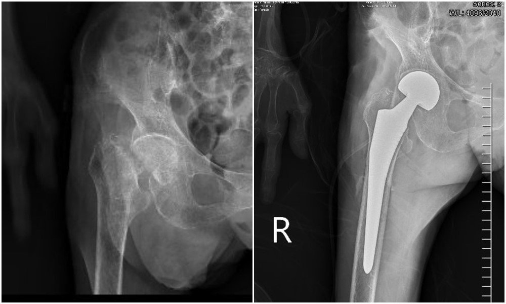 Hình ảnh chụp X-quang trước và sau khi thay khớp háng nhân tạo cho cụ Ch. 107 tuổi
