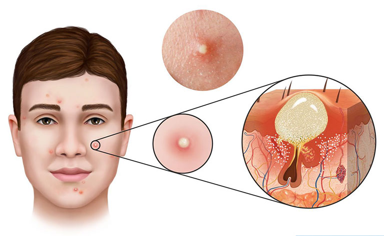 Lỗ chân lông bị bít tắc là nguyên nhân chính dẫn tới mụn trên da