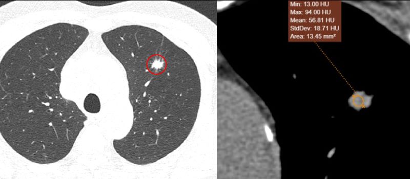 Ảnh chụp CT cho thấy khối (đốm trắng khoanh đỏ) ở thùy trên phổi trái bệnh nhân - Ảnh: BVCC