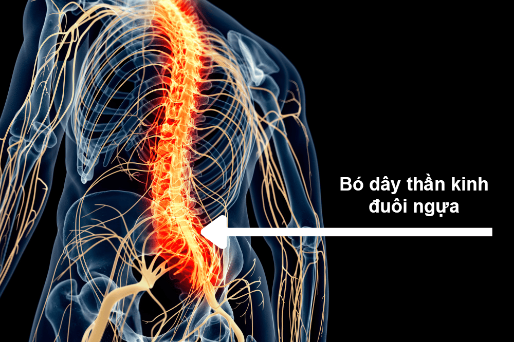 Các rễ của đám rối thần kinh đuôi ngựa bị chèn ép dẫn đến đau nhức, tê bì