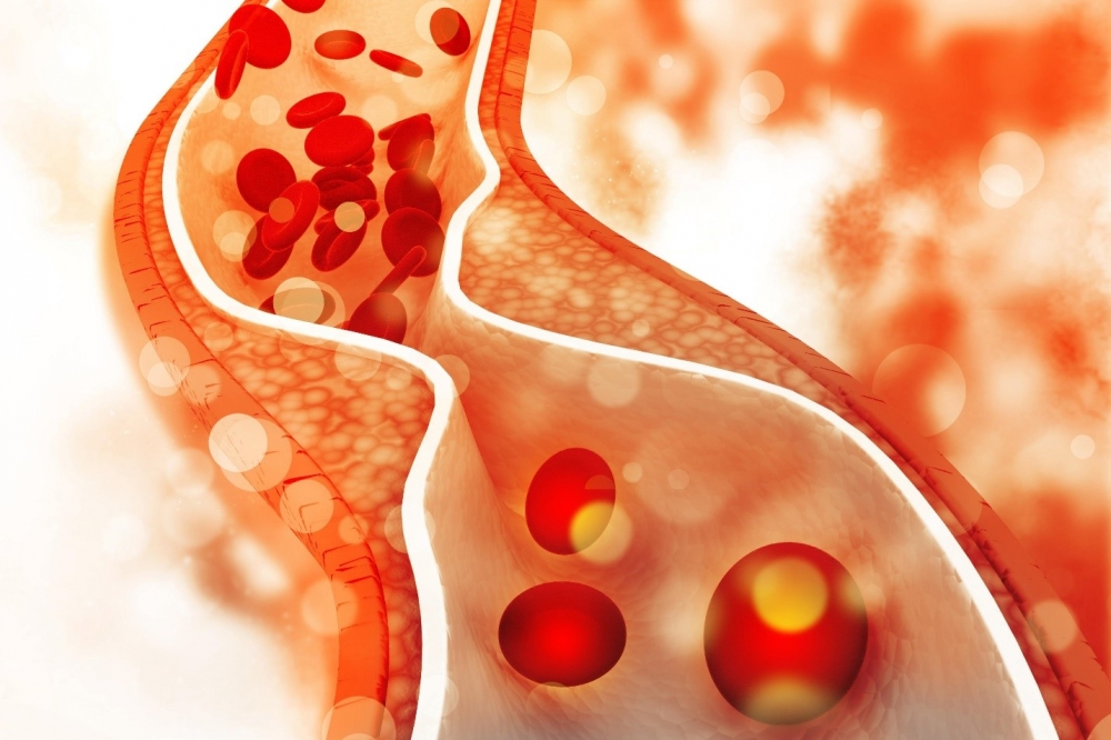 Nồng độ cholesterol “xấu” LDL cao có thể làm tăng nguy cơ xơ vữa động mạch