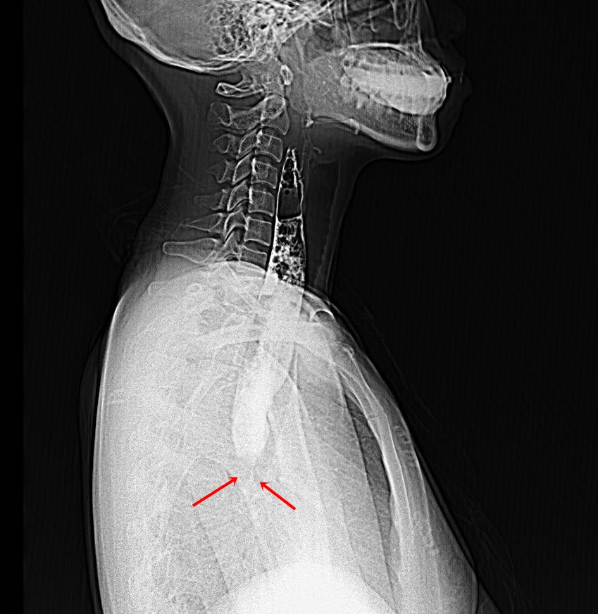 Hình ảnh X-quang ứ đọng thuốc cản quang thực quản, co thắt tại vị trí tâm vị - Ảnh: BVCC