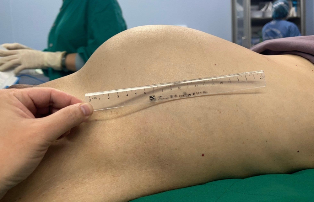 Hình ảnh bụng bệnh nhân trước phẫu thuật - Ảnh: BVCC
