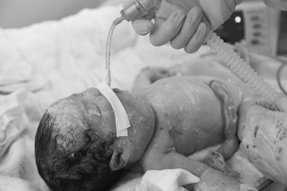 Em bé ra đời được đặt nội khí quản thành công và chuyển viện an toàn đến Bệnh viện Nhi đồng Thành phố - Ảnh: Sức khỏe & Đời sống